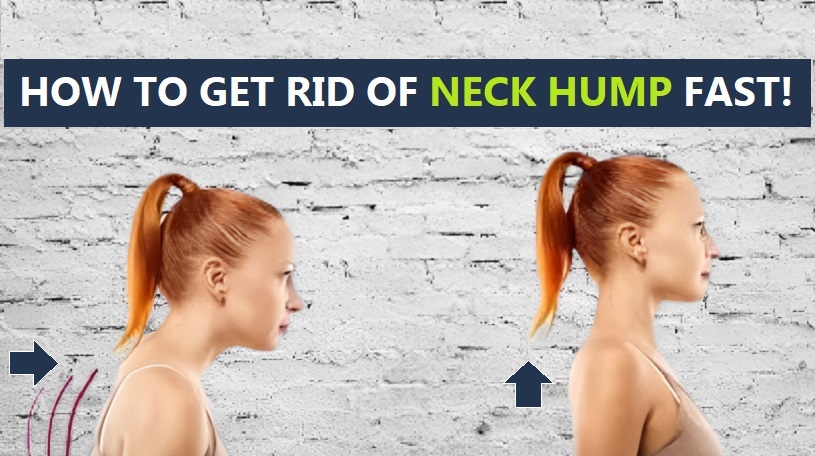 how to get rid of a neck hump fast