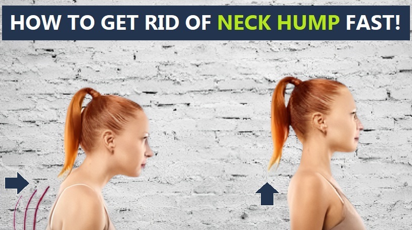 How To Get Rid Of Neck Hump Fast: The 3 Best Exercises